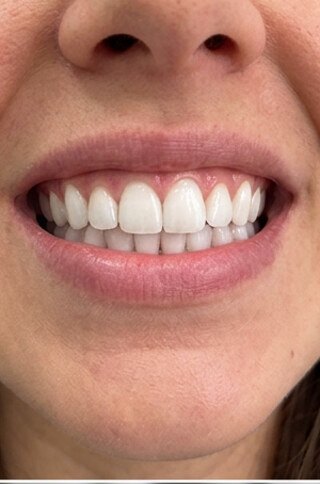 Caso real de blanqueamiento dental en DAC Odontología