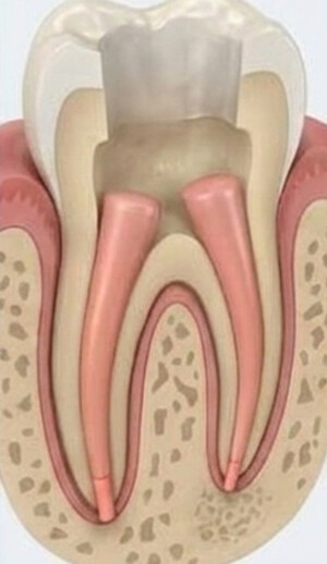 Caso real de endodoncia en DAC Odontología