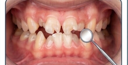 Paso 1: diagnostico, dientes apinados
