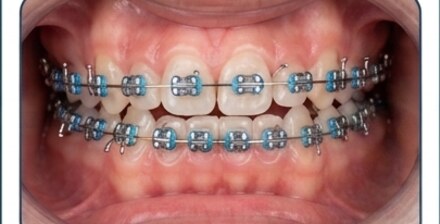 Paso 2: instalacion de brackets