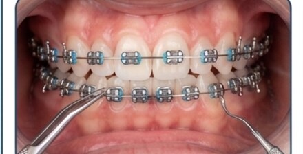 Paso 3: tratamiento y ajustes