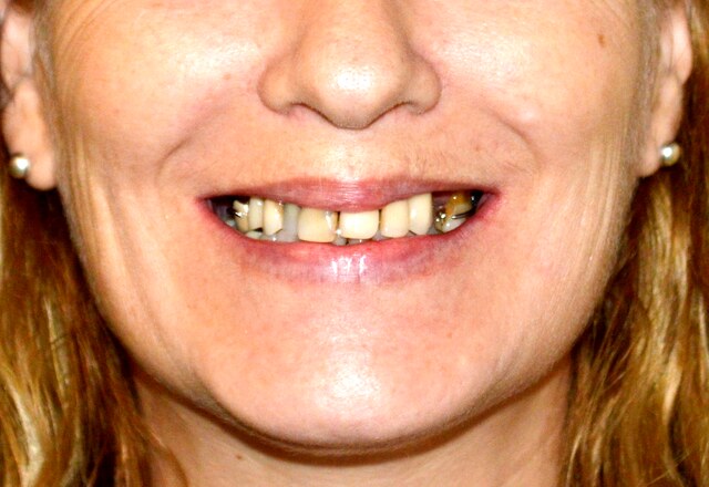 Antes: dientes desgastados