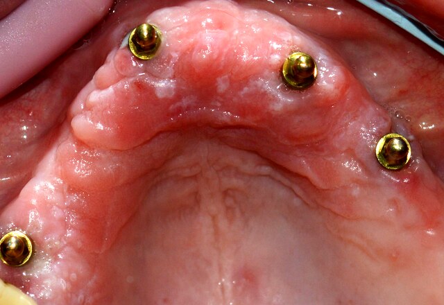 Pilares de bola sobre implantes en el maxilar